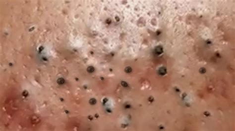 best pimple popper video|blackhead extraction videos 2024.